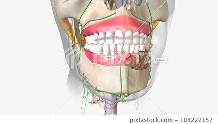 Once a tumor has spread into nearby lymph nodes, it is considered a stage three cancer. Once a tumor has spread into nearby lymph nodes, it is considered a stage three cancer. 103222152