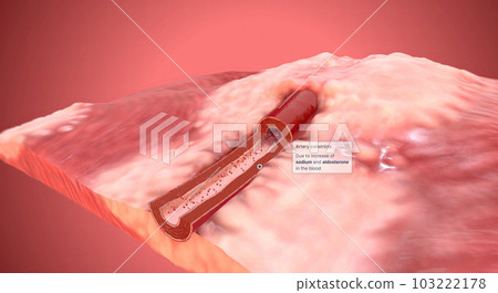 Due to increase of sodium and aldosterone in the blood artery constrict 103222178