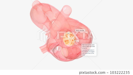 Narrowed aortic valve cannot open and close properly 103222235