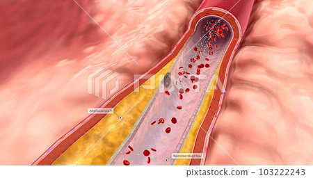 Atherosclerosis can sometimes narrow arteries that blood to the heart is restricted. Atherosclerosis can sometimes narrow arteries that blood to the heart is restricted. 103222243