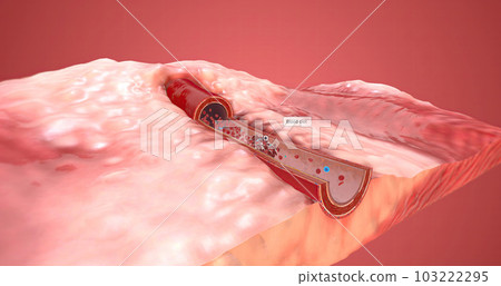 A blood clot is red blood cells that stick together in the bloodstream and are held in place by fibrin. 103222295