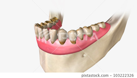 Dental erosion, also known as tooth erosion 103222326