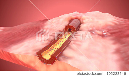 Due to increase of sodium and aldosterone in the blood artery constrict 103222346