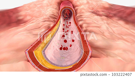 Atherosclerosis is the plaque buildup in the walls of the arteries. Atherosclerosis is the plaque buildup in the walls of the arteries. 103222407