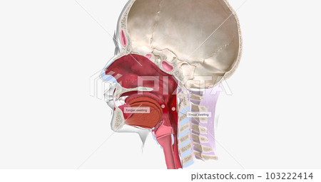 Anaphylaxis is a severe, systemic allergic reaction characterized by swelling of the tongue, throat, or airways. Anaphylaxis is a severe, systemic allergic reaction characterized by swelling of the tongue, throat, or airways. 103222414