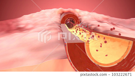 Artery dilates due to increase of ARBs in the blood 103222671