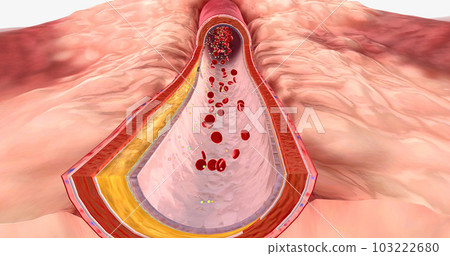 Atherosclerosis is the plaque buildup in the walls of the arteries. Atherosclerosis is the plaque buildup in the walls of the arteries. 103222680