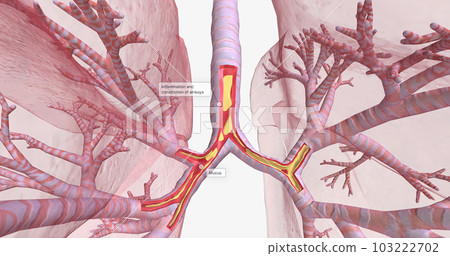 Inflammation and constriction of airways Inflammation and constriction of airways 103222702