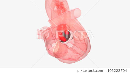 The damaged aortic valve may also be replaced with a mechanical or a biological tissue valve. The damaged aortic valve may also be replaced with a mechanical or a biological tissue valve. 103222704