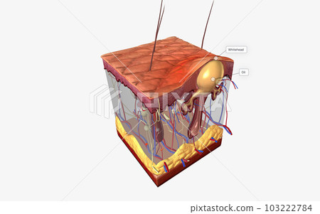 Closed comedones (whiteheads) are a type of acne characterized by small pink bumps with white, pus-filled centers. 103222784