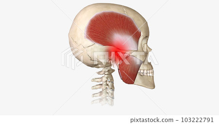 Bruxism is a disorder characterized by abnormal tooth wear due to grinding and clenching of the jaw muscles. Bruxism is a disorder characterized by abnormal tooth wear due to grinding and clenching of the jaw muscles. 103222791