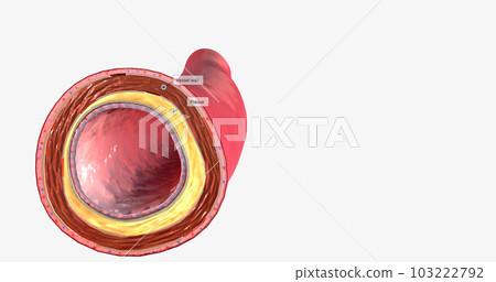 As atherosclerosis progresses, the cholesterol forms a plaque within the wall of the artery. As atherosclerosis progresses, the cholesterol forms a plaque within the wall of the artery. 103222792
