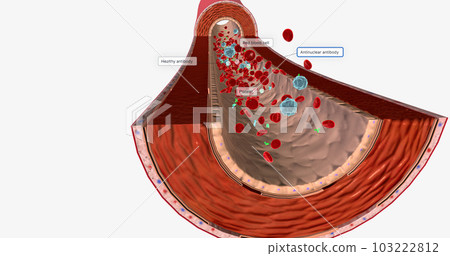 Blood Flow with Antinuclear Antibody Blood Flow with Antinuclear Antibody 103222812