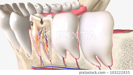 Dental caries, or cavities, are areas of tooth decay caused by acid-producing bacteria in the mouth. Dental caries, or cavities, are areas of tooth decay caused by acid-producing bacteria in the mouth. 103222835