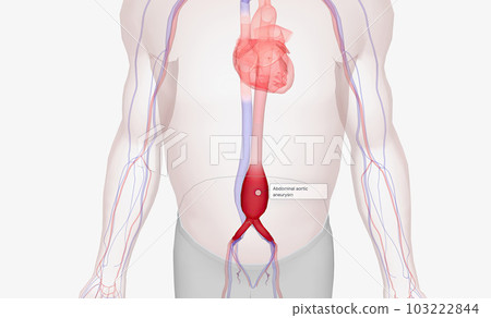 Abdominal aortic aneurysm occurs when the abdominal aorta balloons out due to the weakening of the wall of the artery. Abdominal aortic aneurysm occurs when the abdominal aorta balloons out due to the weakening of the wall of the artery. 103222844