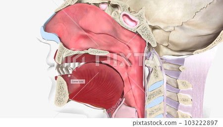 Canker sores (also called aphthous ulcers) are small, round sores on the inside of the mouth or base of the gums. 103222897