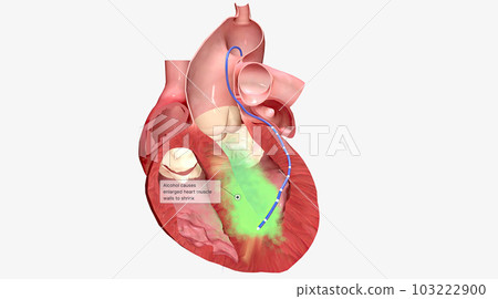In alcohol septal ablation, a small amount of pure alcohol is released into an artery at the septum 103222900