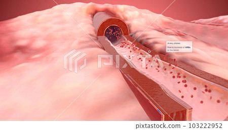 Artery dilates due to increase of ARBs in the blood Artery dilates due to increase of ARBs in the blood 103222952