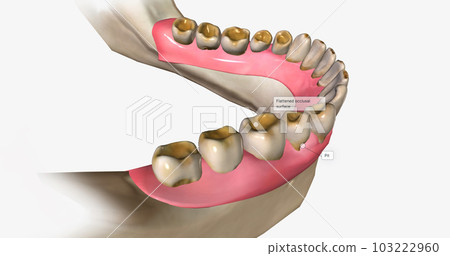 Dental erosion, also known as tooth erosion Dental erosion, also known as tooth erosion 103222960