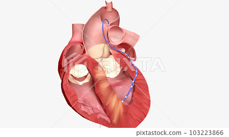 Alcohol causes enlarged heart muscle walls to shrink 103223866