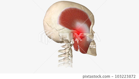Bruxism is a disorder characterized by abnormal tooth wear due to grinding and clenching of the jaw muscles. 103223872