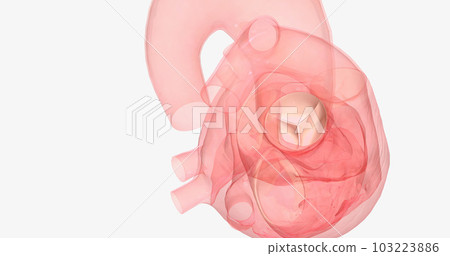 The aortic valve is between the left ventricle of the heart and the aorta, the largest artery in the body. The aortic valve is between the left ventricle of the heart and the aorta, the largest artery in the body. 103223886