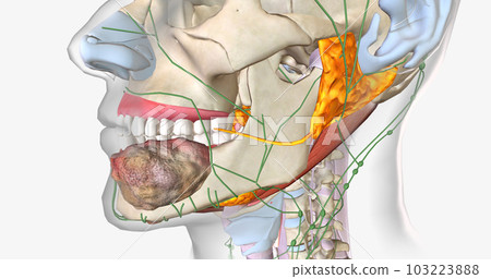 Once a tumor has spread into nearby lymph nodes, it is considered a stage three cancer. Once a tumor has spread into nearby lymph nodes, it is considered a stage three cancer. 103223888