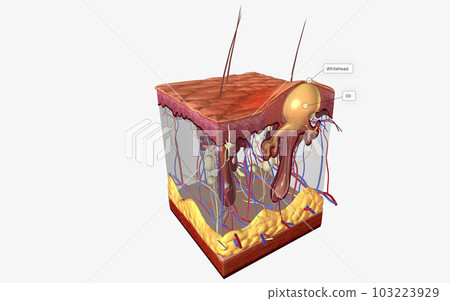 Closed comedones (whiteheads) are a type of acne characterized by small pink bumps with white, pus-filled centers. Closed comedones (whiteheads) are a type of acne characterized by small pink bumps with white, pus-filled centers. 103223929