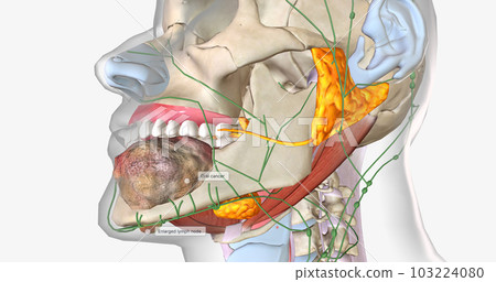 Once a tumor has spread into nearby lymph nodes, it is considered a stage three cancer. Once a tumor has spread into nearby lymph nodes, it is considered a stage three cancer. 103224080