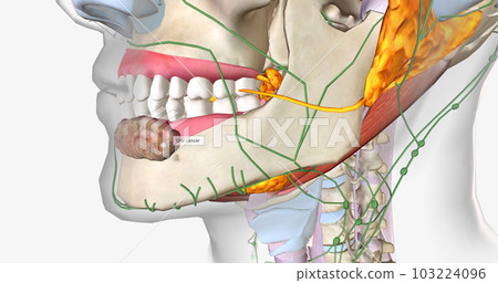 Once a tumor has spread into nearby lymph nodes, it is considered a stage three cancer. Once a tumor has spread into nearby lymph nodes, it is considered a stage three cancer. 103224096