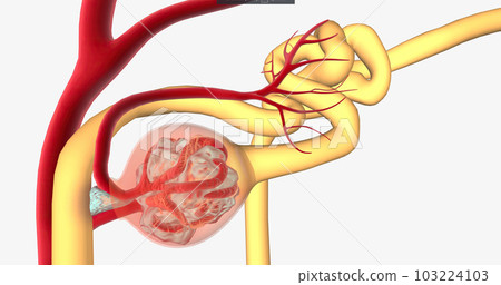 Glomerulonephritis is a group of renal conditions characterized by inflammation of the glomeruli within the kidney. Glomerulonephritis is a group of renal conditions characterized by inflammation of the glomeruli within the kidney. 103224103