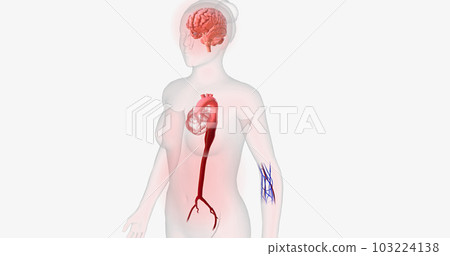 Aortitis is a rare condition characterized by inflammation of the aorta. Aortitis is a rare condition characterized by inflammation of the aorta. 103224138