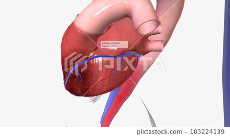 Angina is chest pain or discomfort due to reduced blood flow to the heart. 103224139