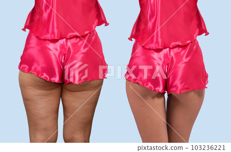 Woman's thighs and buttocks with cellulite. 103236221