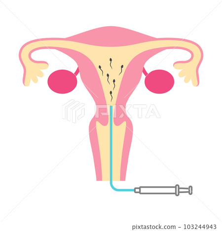 Illustration of artificial insemination Illustration of artificial insemination 103244943