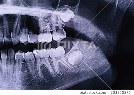 Panoramic X-ray of the jaw. X-ray of the teeth of a 12-year-old girl 103250875