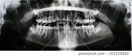 Panoramic X-ray of the jaw. X-ray of the teeth of a 12-year-old girl Panoramic X-ray of the jaw. X-ray of the teeth of a 12-year-old girl 103250882