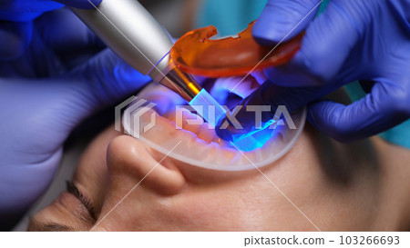 Dentist treating caries and illuminating seal with ultraviolet lamp closeup Dentist treating caries and illuminating seal with ultraviolet lamp closeup 103266693