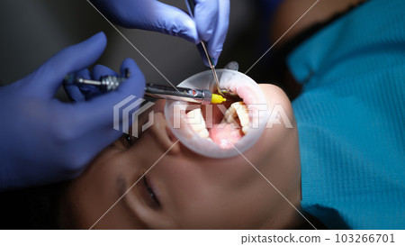 Dentist injecting anesthetic into patient gum for painless dental treatment closeup 103266701