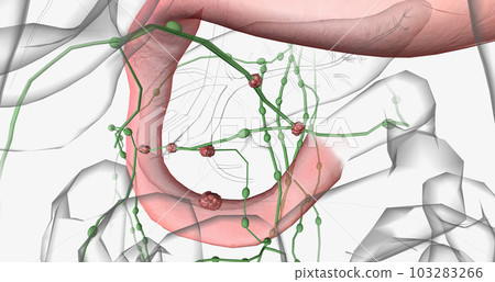 A Cystocele is Also Known As a Bladder Prolapse, a Fallen Bladder