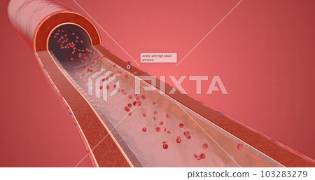 Artery with high blood pressure 103283279