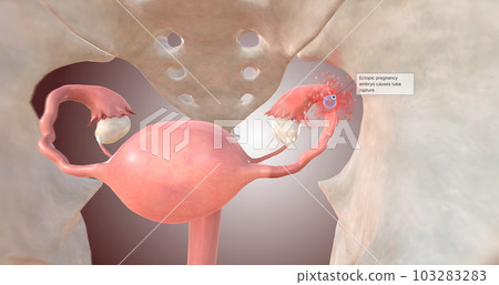 Ectopic pregnancy embryo causes tube rupture 103283283