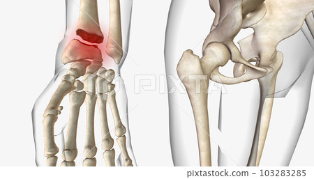 Distal radius fractures are among the most common types of fractures and are most common in the upper extremities. Distal radius fractures are among the most common types of fractures and are most common in the upper extremities. 103283285