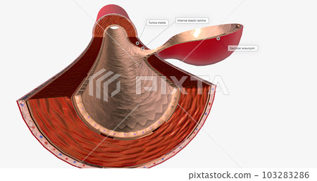 The majority of brain aneurysms are saccular aneurysms that are round and expand from one side of the vessel. The majority of brain aneurysms are saccular aneurysms that are round and expand from one side of the vessel. 103283286