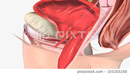 Grade 4 describes a cystocele in which the bulge is entirely past the vaginal opening. Grade 4 describes a cystocele in which the bulge is entirely past the vaginal opening. 103283288