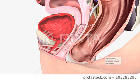 Grade 2 describes a rectocele in which the bulge reaches the level of the hymen, or vaginal opening, without passing it. 103283295