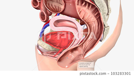 Complete prolapse of the rectum past the vaginal opening 103283301