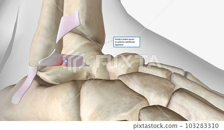 Lateral Ankle Sprain Torn Anterior Talofibular Ligament Lateral Ankle Sprain Torn Anterior Talofibular Ligament 103283310