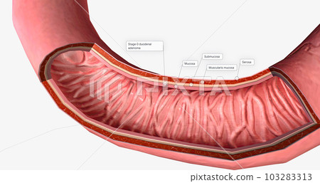The Duodenal Carcinoma, Stage 0 3d The Duodenal Carcinoma, Stage 0 3d 103283313