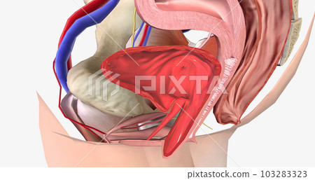 Grade 3 describes a cystocele in which the bulge passes the level of the hymen and is half-way out of the vaginal opening. Grade 3 describes a cystocele in which the bulge passes the level of the hymen and is half-way out of the vaginal opening. 103283323